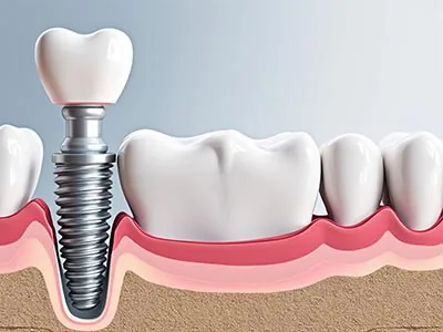 3d rendered image of a single dental implant